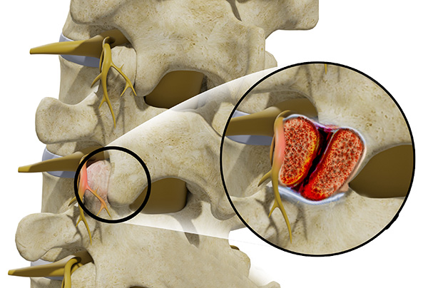 Facet Syndrome (low back and/or neck pain) 