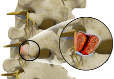 Facet Syndrome (Low Back and/or Neck Pain)