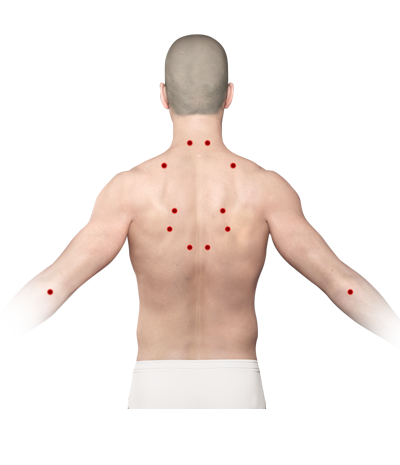 Myofascial Syndrome Trigger Points Chart