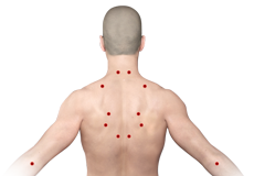 Myofascial Pain Syndrome (Trigger Points)