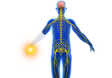 Phantom Limb Pain