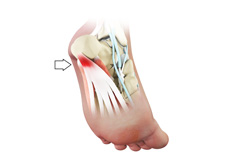 Plantar Fasciitis