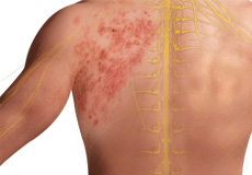 Post Herpetic Neuralgia