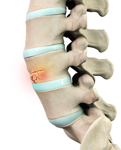 Spinal Compression Fracture Chicago, IL  Spine Osteoporosis Schaumburg,  Crystal Lake