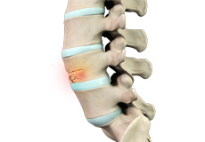 Spinal Compression Fracture