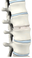 anterior cervical discectomy3