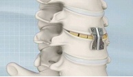 anterior cervical discectomy2