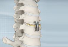 Anterior Cervical Discectomy