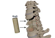 Cervical Corpectomy