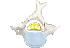 Cervical Laminoplasty