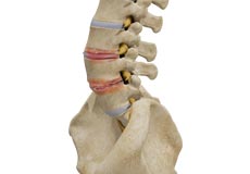 Degenerative Disc Disease