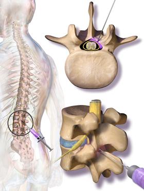 Epidural Spinal Injections