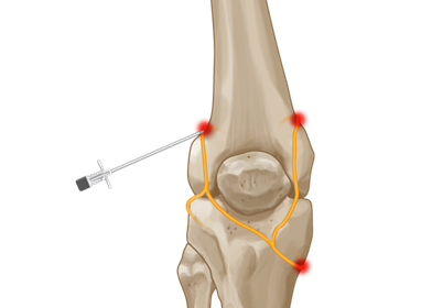 Genicular Nerve Block