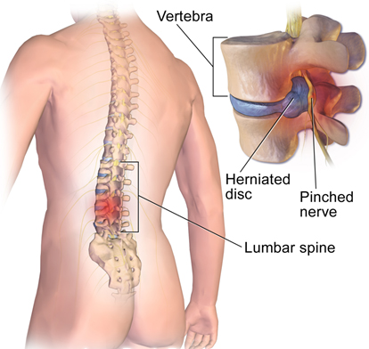 Herniated Discs