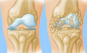 Joint Osteoarthritis