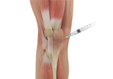 Knee Injection