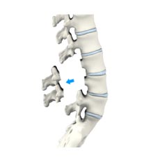 lumbar laminectomy