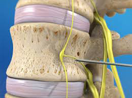 Lumbar Sympathetic Block