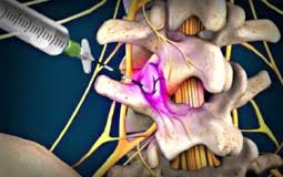 medial-branch-facet-block