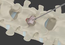 Minimally Invasive Lumbar Discectomy