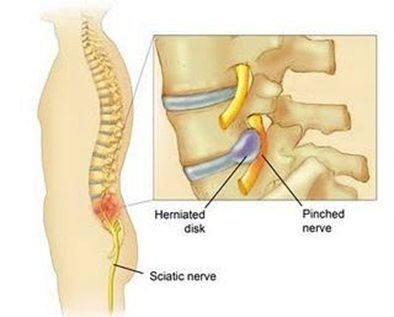 Radiculopathy/Sciatica  