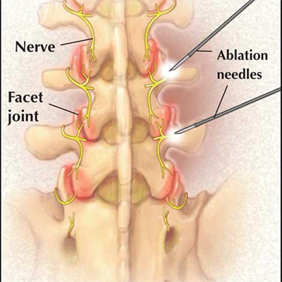 Radiofrequency Ablation