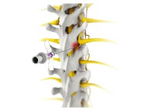 Radiofrequency Ablation (Rhizotomy)