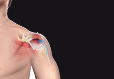 Rotator Cuff Injury