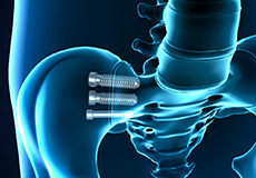 Sacroiliitis/Sacroiliac Joint Arthropathy