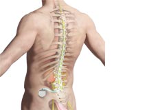 Spinal Cord Stimulator Placement