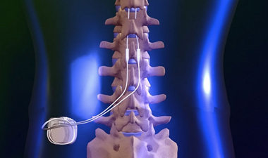 Spinal Cord Stimulation (SCS) in Davenport, IA