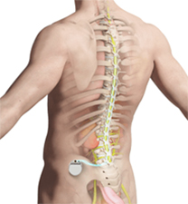 Spinal Cord Stimulation (SCS)