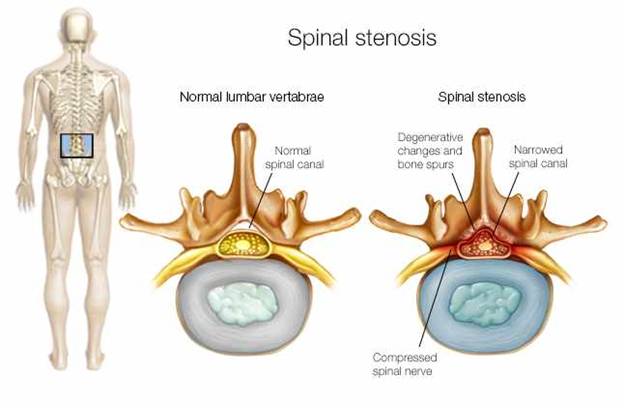 Spinal Stenosis