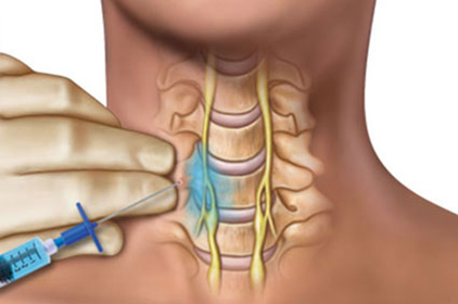 Stellate Ganglion Block