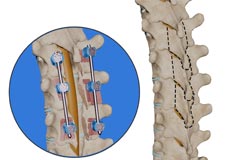 Thoracic Laminectomy