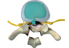 Thoracic Spine Decompression