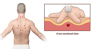 Trigger Point Injection